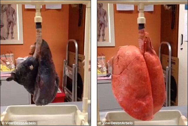 左图是吸烟者肺部变黑,肺活量降低;右图是非吸烟者的健康肺部.
